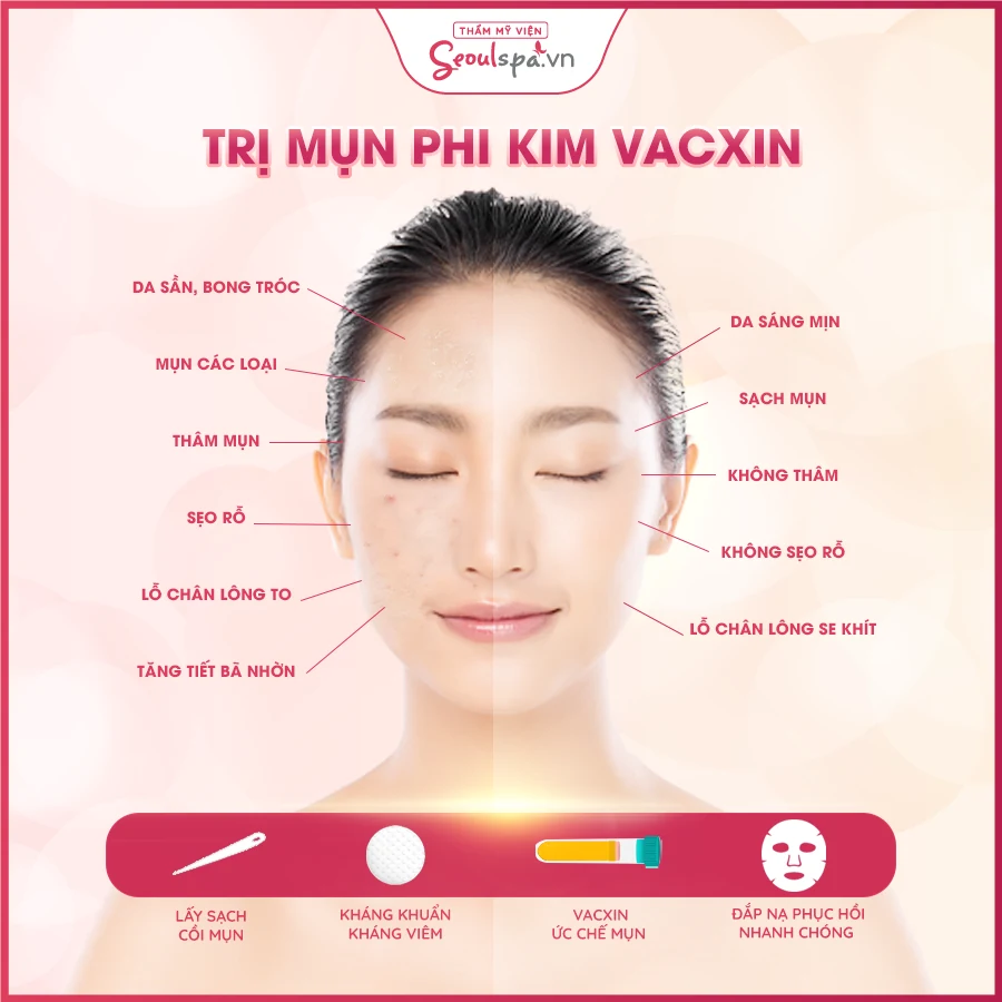 Thẩm mỹ viện Seoul Spa trả lại làn da mịn màng với 4 công nghệ trị mụn