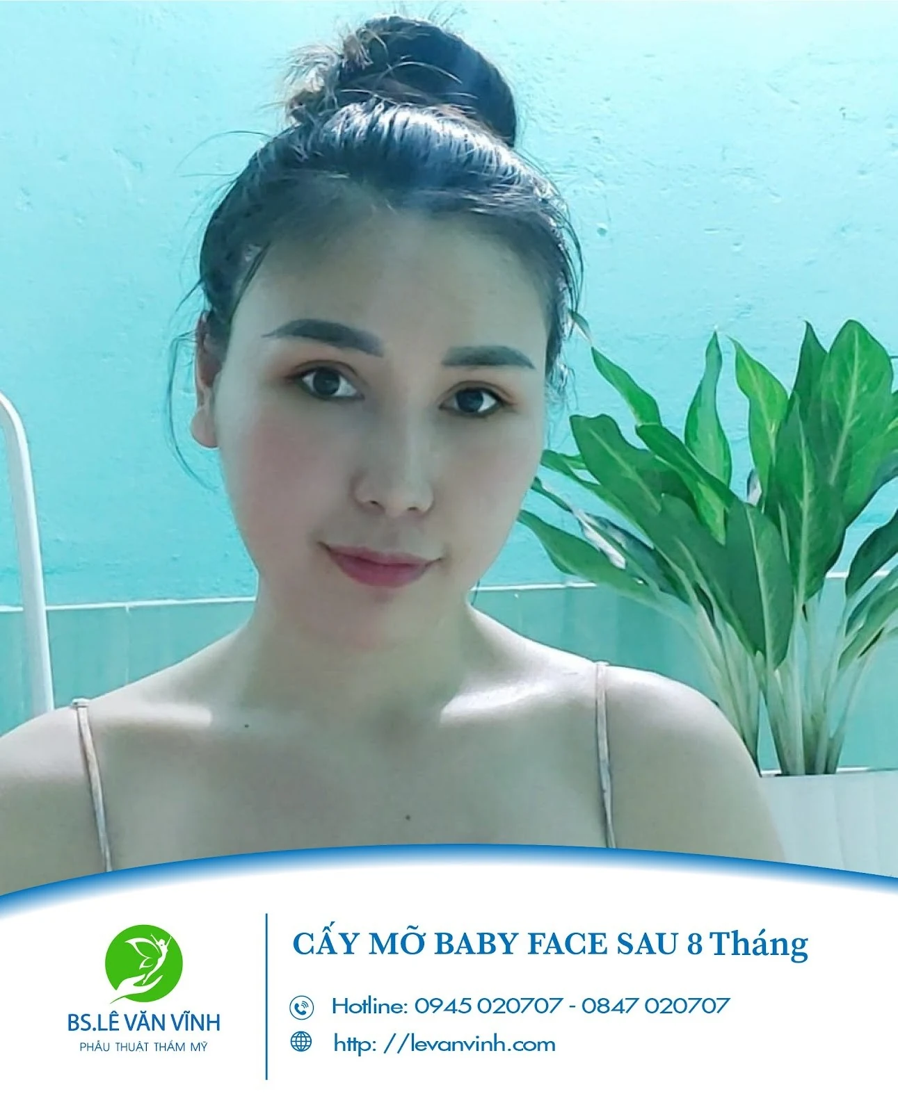 Cấy mỡ mặt xinh lung linh với bác sĩ giỏi