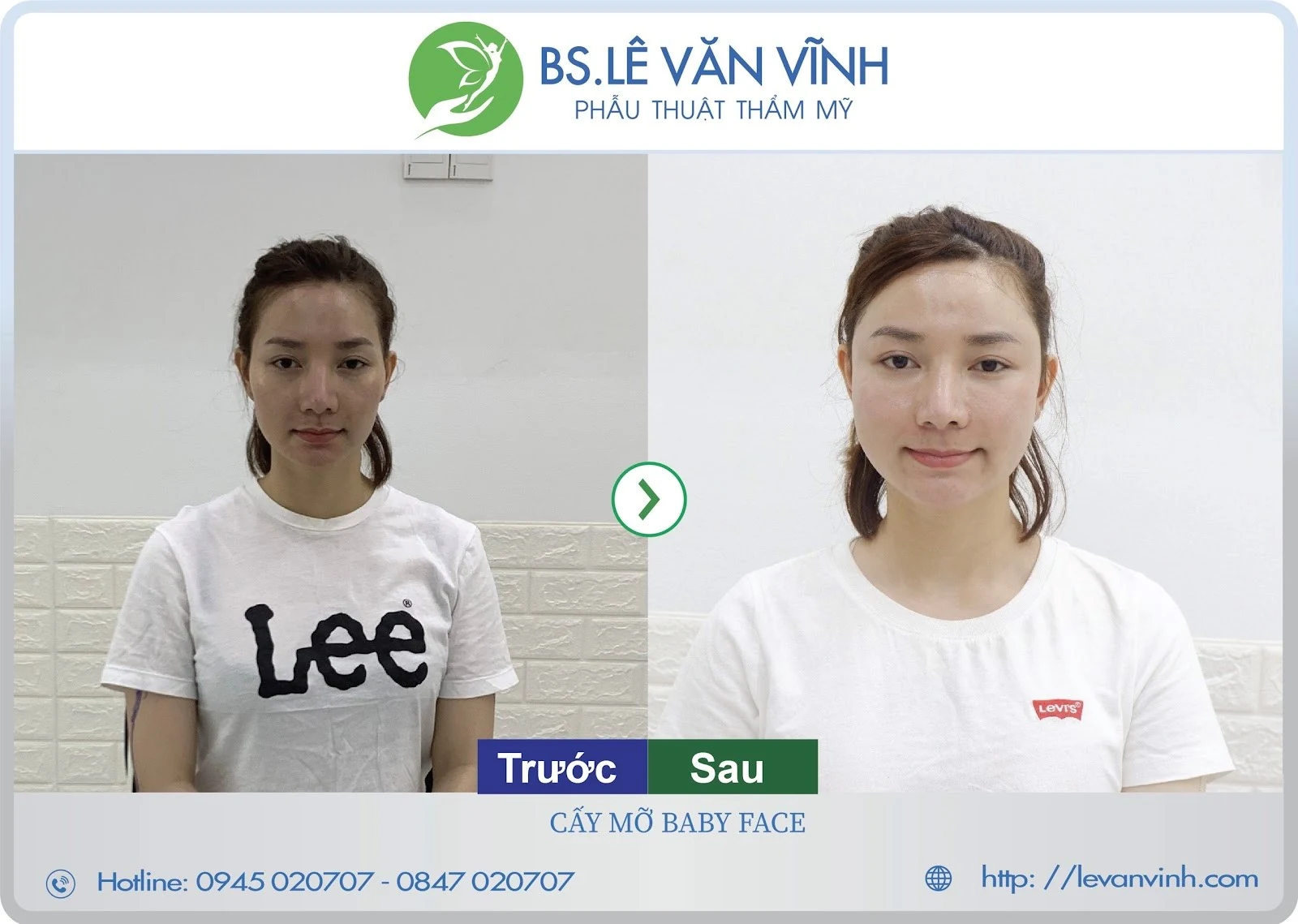 Cấy mỡ mặt xinh lung linh với bác sĩ giỏi