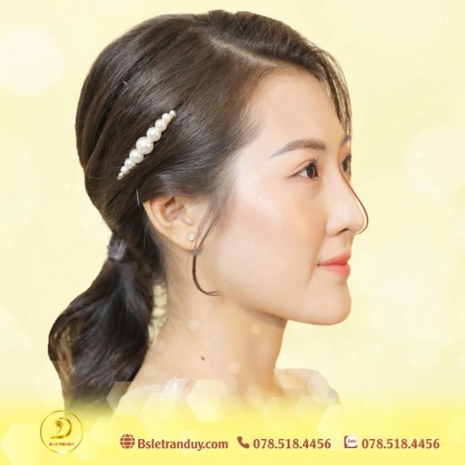 Nâng mũi đẹp không khó bởi bác sĩ tài năng