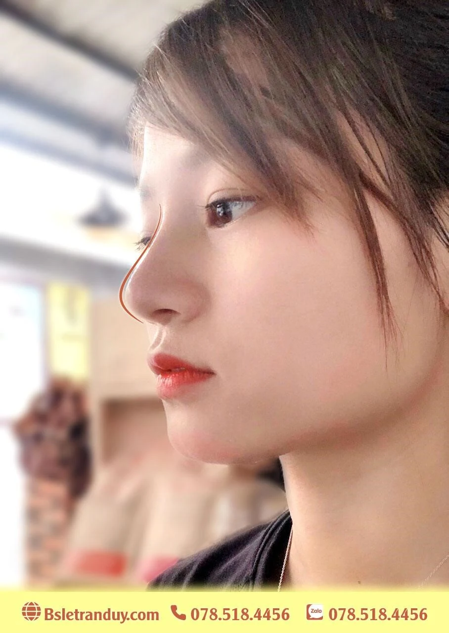 Nâng mũi đẹp không khó bởi bác sĩ tài năng