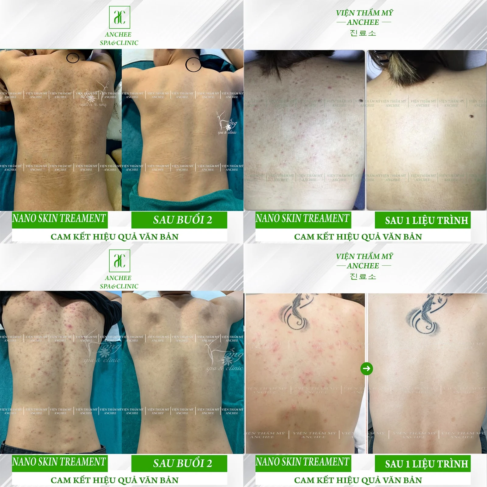 Bống Spa: Chia sẻ 4 cách trị mụn lưng tại nhà hiệu quả