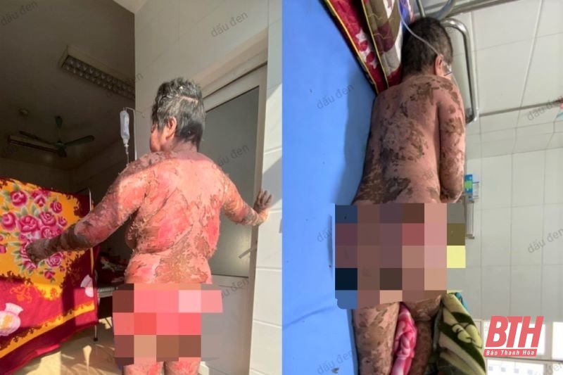 Suýt mất mạng vì sử dụng thuốc nam không rõ nguồn gốc gây ra hội chứng Lyell