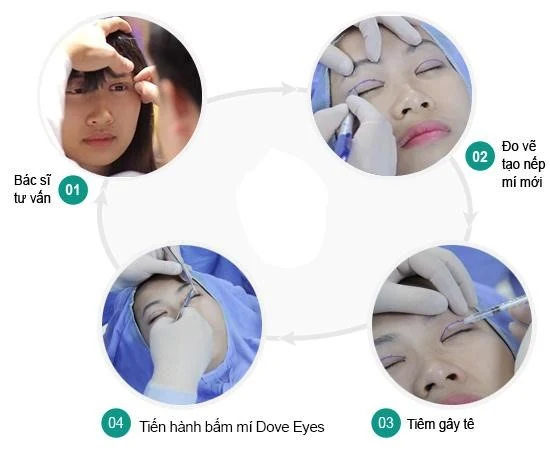 Nhấn mí mắt đẹp ở Bác Sĩ Lê Văn Vĩnh