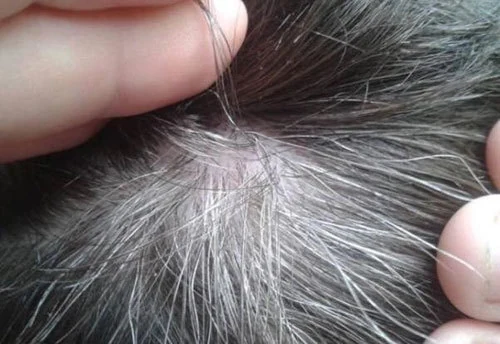 Góc nhìn của chuyên gia da liễu về các vấn đề tóc nam giới phổ biến hiện nay?