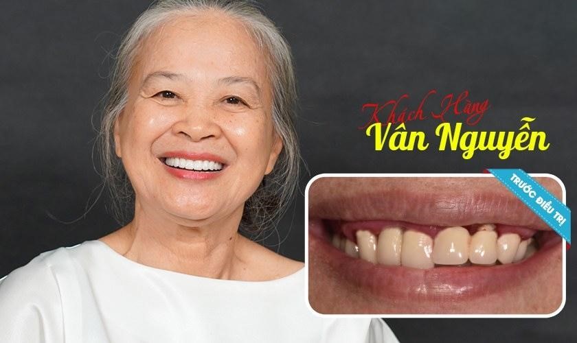 3 tiêu chí đánh giá ca cấy ghép Implant thành công