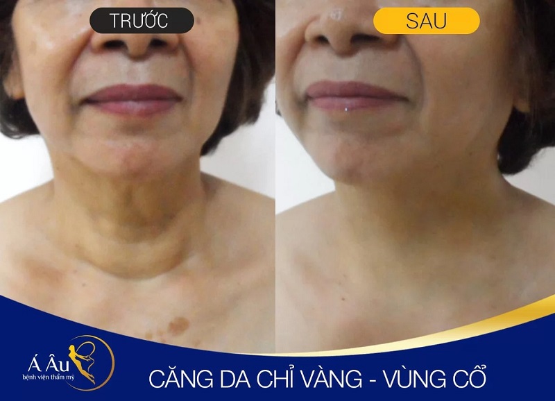 Căng da mặt bằng chỉ vàng chất lượng tại Bệnh Viện Thẩm Mỹ Á Âu