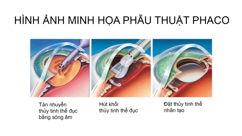 Phẫu thuật Phaco trong điều trị đục thủy tinh thể