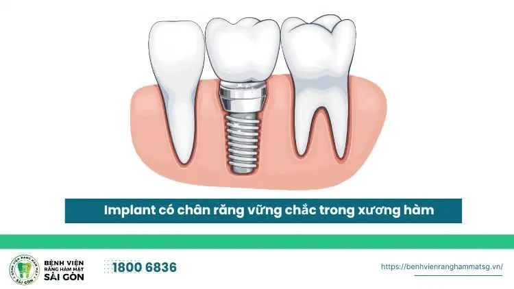 Cấy đăng ký m88 - Giải pháp khôi phục hàm răng chắc khỏe