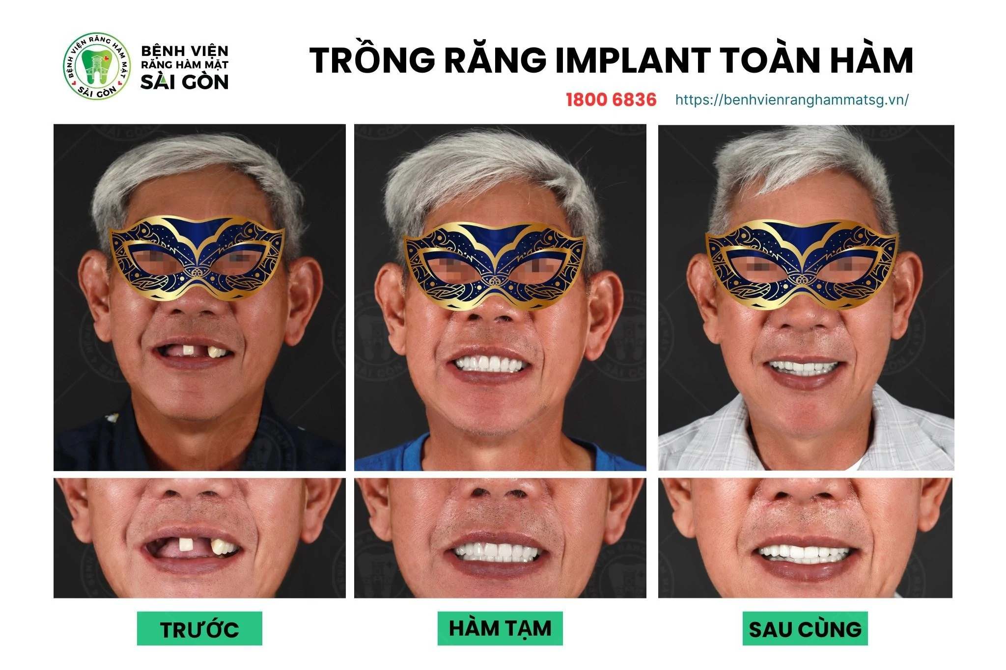 Cấy đăng ký m88 - Giải pháp khôi phục hàm răng chắc khỏe