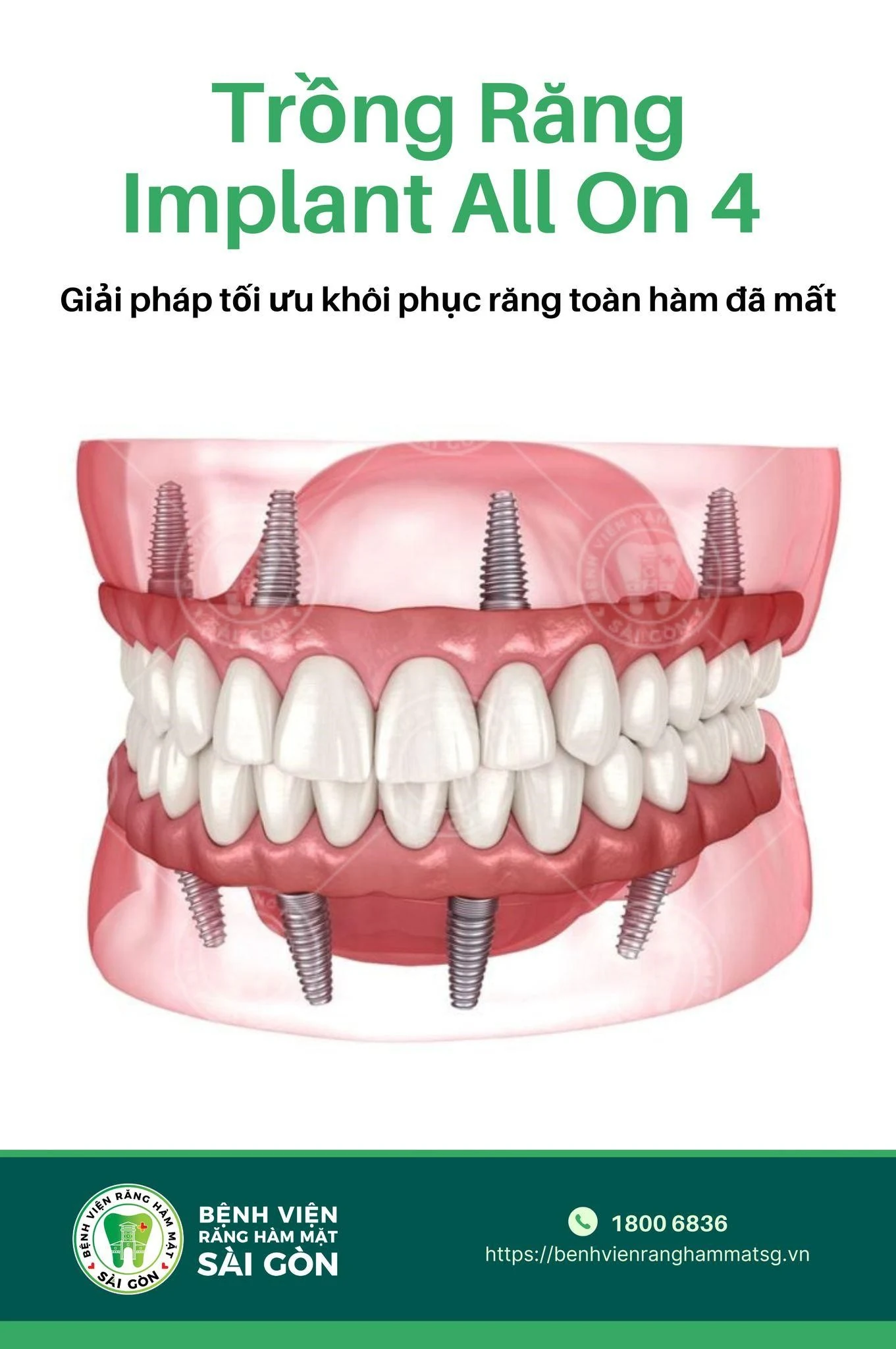 Cấy đăng ký m88 - Giải pháp khôi phục hàm răng chắc khỏe
