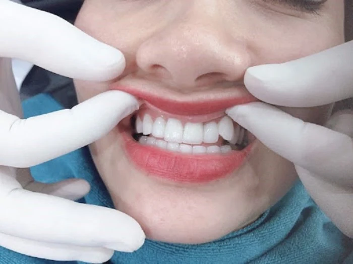 Khi nào nên và không nên bọc răng sứ?