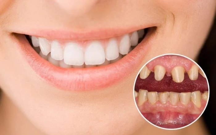 Khi nào nên và không nên bọc răng sứ?