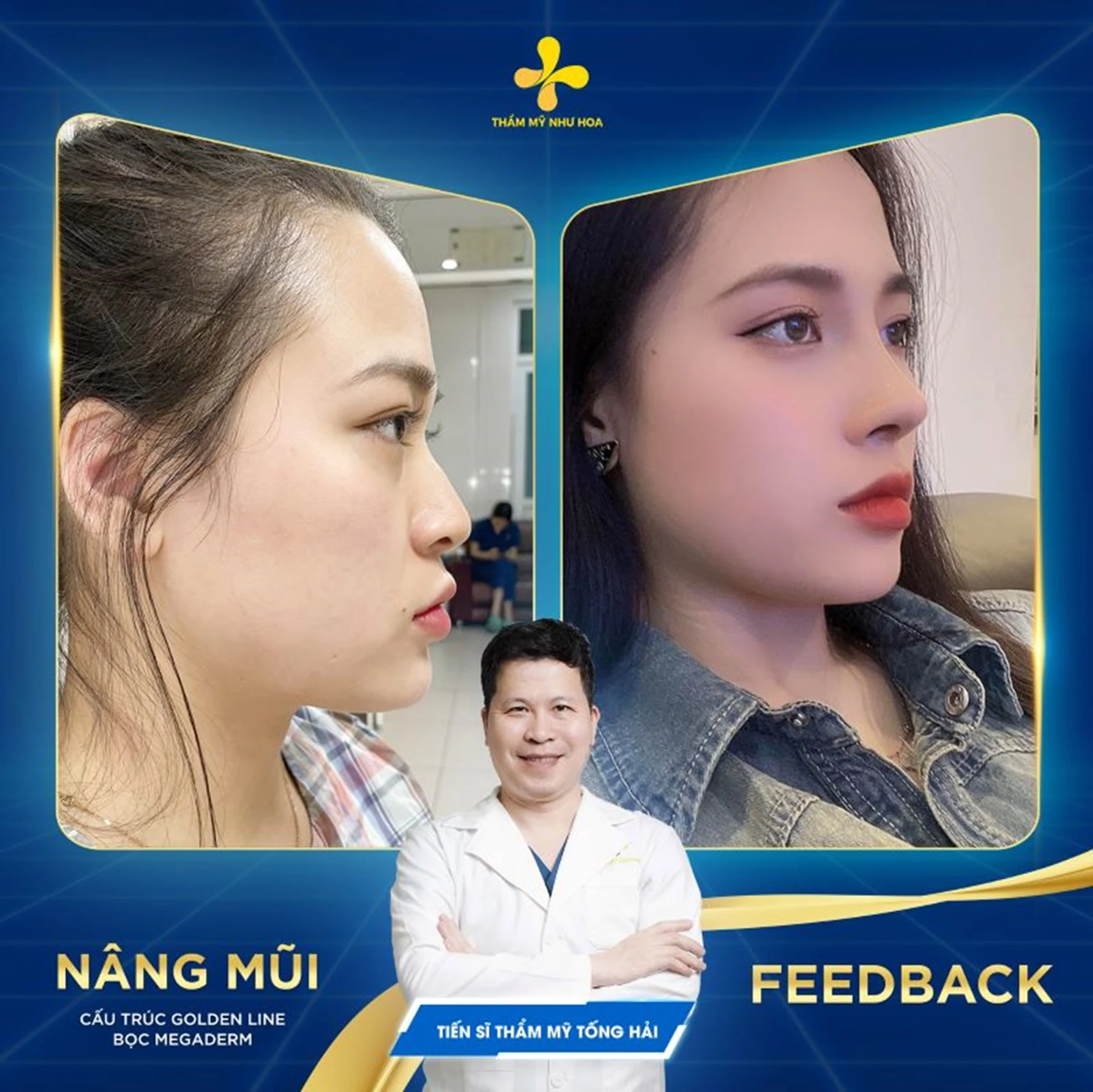 Nâng mũi cấu trúc là gì? Những điều bạn cần biết trước khi phẫu thuật