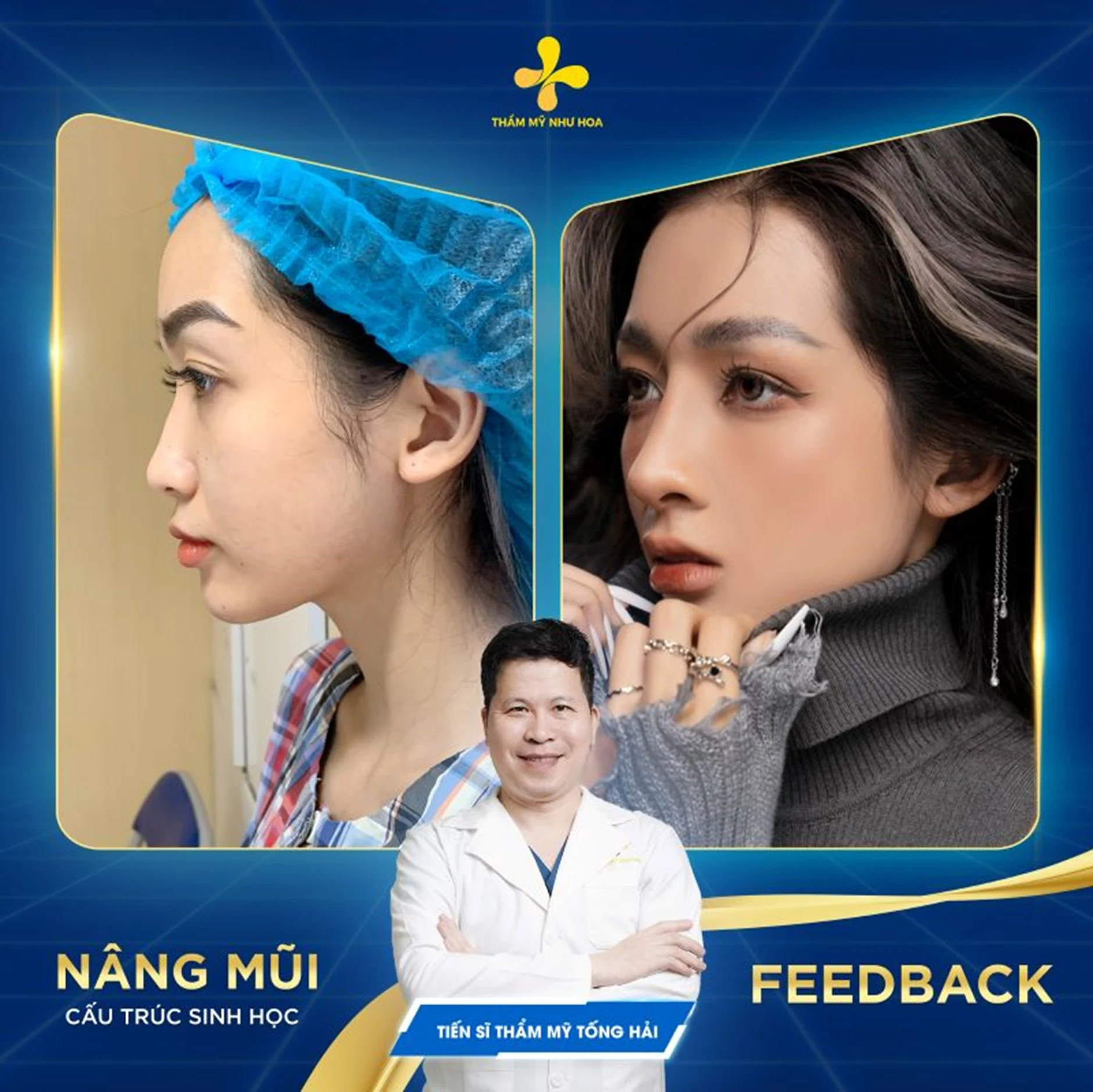 Nâng mũi cấu trúc là gì? Những điều bạn cần biết trước khi phẫu thuật