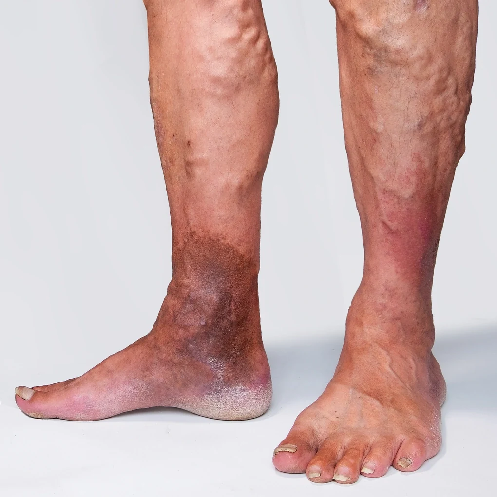 Suy giãn tĩnh mạch - căn bệnh thầm lặng đe dọa sức khỏe tuổi trung niên