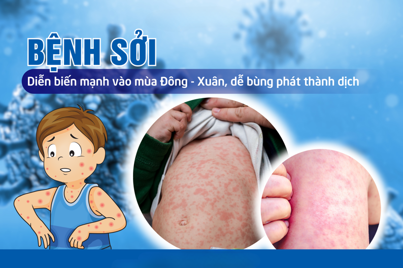 Triển khai chiến dịch tiêm chủng vaccine phòng, chống dịch Sởi năm 2025 đợt 2