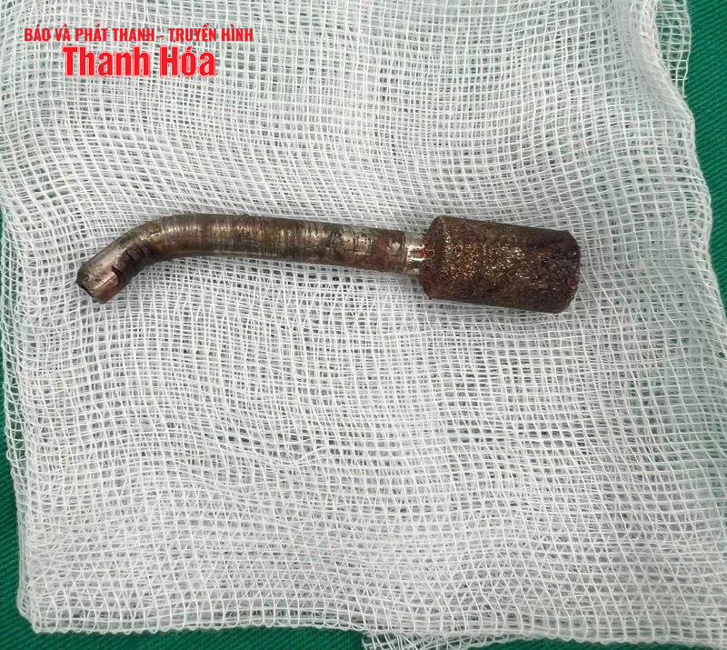 Ca phẫu thuật cấp cứu hy hữu: Bệnh nhân bị mũi khoan thép đâm xuyên hốc mũi