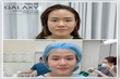 Cắt mí mắt đẹp như ý với bác sĩ giỏi