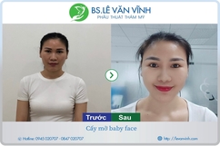 Cấy mỡ mặt xinh lung linh với bác sĩ giỏi