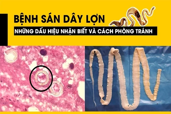[Infographics] Bệnh sán dây lợn - Những dấu hiệu nhận biết và cách phòng tránh