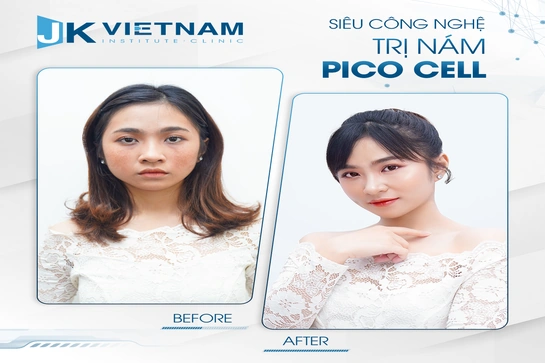 Chữa nám 10 năm không khỏi, mẹ bỉm nhận kết quả bất ngờ sau 60 phút