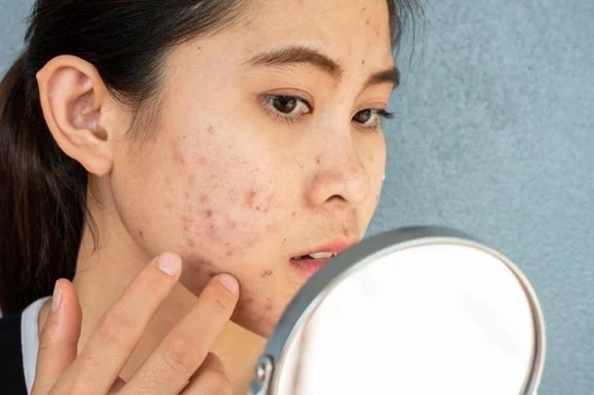 Bị nổi mụn mãi không hết - Đừng vội bỏ qua bài viết này!